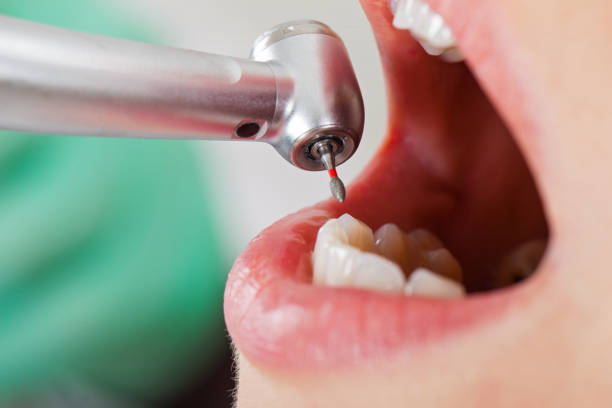 Best Emergency Treatment for Dental Infections or Abscesses in Rockcreek, OR